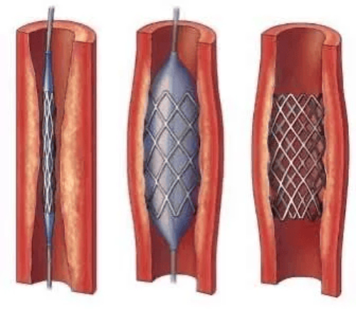 Nitinol Stent Deployment Nitinol Stent Deployment