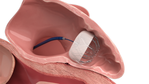 Cardiac Occluder Cardiac Occluder