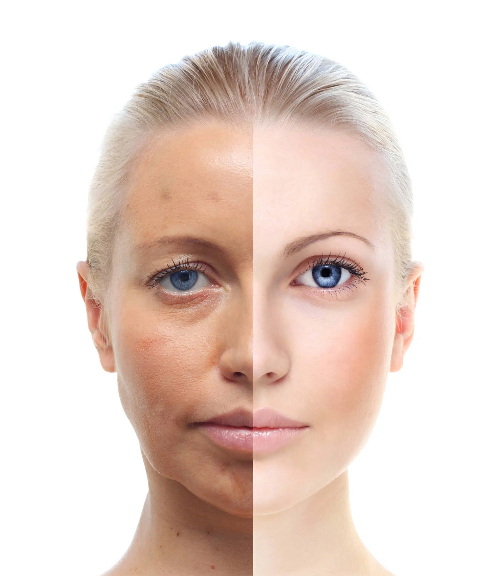 Comparison of Photoaged Skin vs. Young Skin